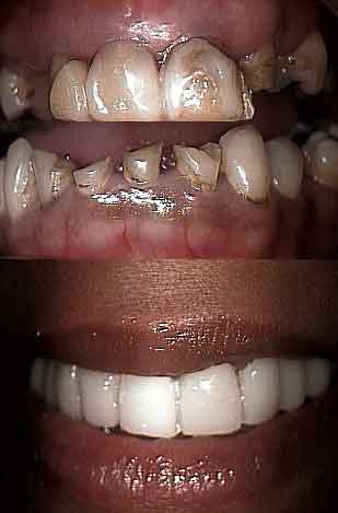 Full mouth reconstruction, dental bridge, fixed caps, dental crown, oral rehabilitation, lab processed temp temporary