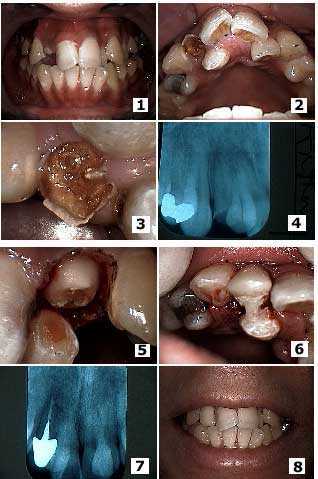 supernumerary extra tooth broken fracture chipped cracked cracks x-ray decay occlusion