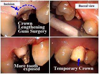 temporary dental crown lengthening gum surgery periodontal gingival therapy, tooth teeth