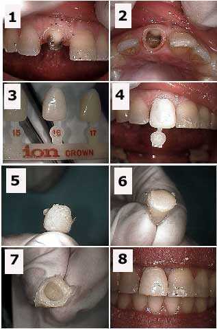 temporary dental crown cap technique ion crown form provisional how to drill proximal contact