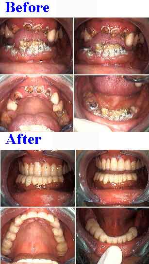 oral rehabilitation dental reconstruction smile makeover fear phobia afraid Dr Dorfman