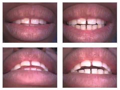 tongue thrust, open bite, oral habits, diagnosis of a tongue thrust