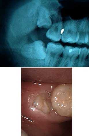 second 2nd molar damage, Wisdom Teeth Tooth, third 3rd molar, pericoronitis, gum pocket 