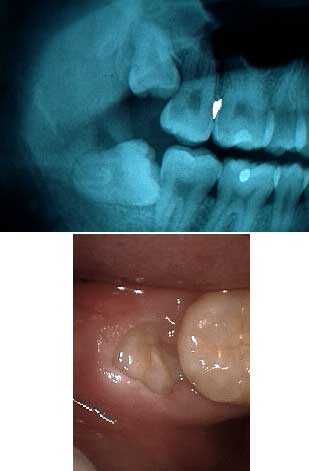 full mouth extraction