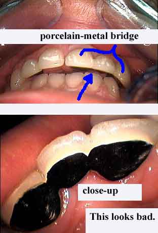 tooth bridge showing palatal lingual metal framework, pfm tooth bridges, dental caps