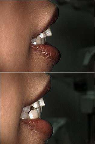 Clear braces invisible orthodontics treatment for overjet over jet or buck teeth improve a smile.