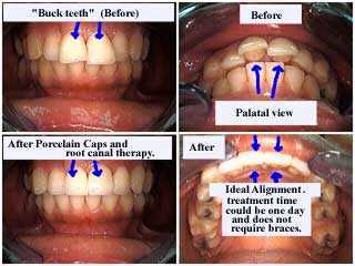 tooth buck teeth overjet, central teeth, crowns, porcelain caps alignment over jet dental occlusion