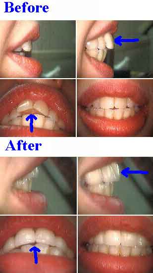 ceramic teeth crowns, all porcelain caps, front tooth protrusion, allergic dermatitis