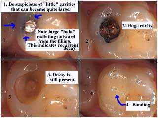 tooth decay cavity teeth cavities dental caries small amalgam silver filling carious lesions