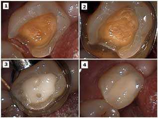 Cavity, Decay, Filling, Composite, Bonding, Bonding Balls, Tooth Preparation, Technique