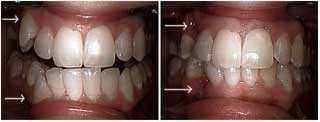cosmetic dentistry crowded crooked teeth pushed out labial dental bonding extraction canine tooth