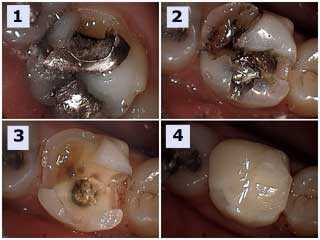 tooth cusp fractures chipped broken cavity dental caries cavities silver filling amalgam bonding