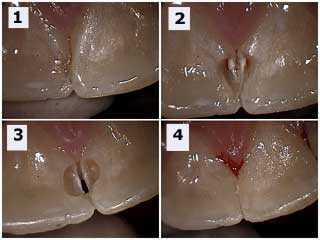 tooth decay cavities cavity between teeth dental caries interproximal lesion bonding composite
