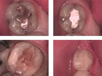 tooth decay, cavity, dental caries, how to cosmetic bonding, composite resin material