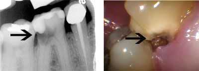 tooth decay, cavity, dental caries, x-ray, photo, picture, diagnosis, extraction