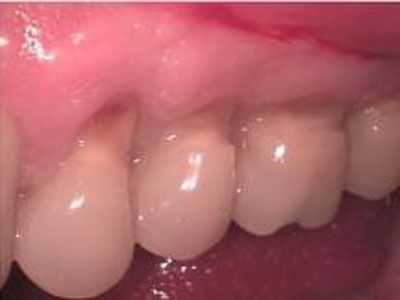 Tooth erosion, toothbrushing, toothbrush, erosion of teeth
