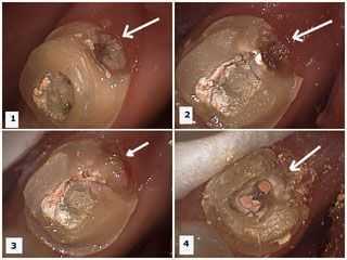 root canal therapy tooth pain swelling abscess direct pulp nerve exposure cap wisdom teeth tooth