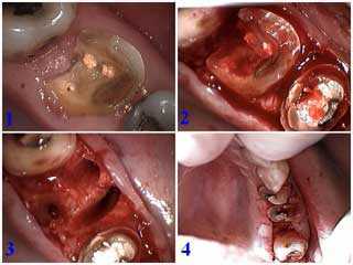 hopeless tooth extraction dental implants surgical photos pictures subgingival decay cavity dental caries pain