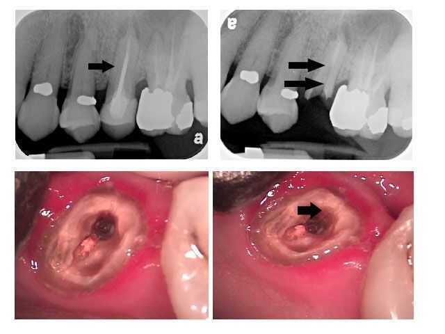 tooth fracture chipped cracked broken teeth trauma injury craze lines diagnosis xray photos 