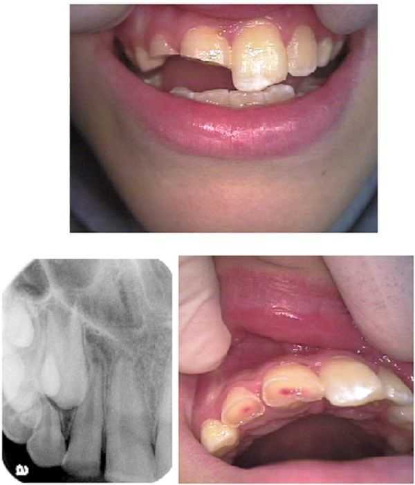broken tooth, tooth root apex, apexification, accident, teeth trauma, partial pulpotomy, falling, s