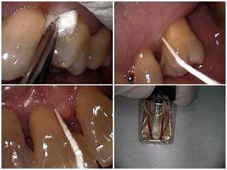 diabetes and periodontal disease, gum disease, gingivitis, AA PG bacteria oral microbiology,  porphy