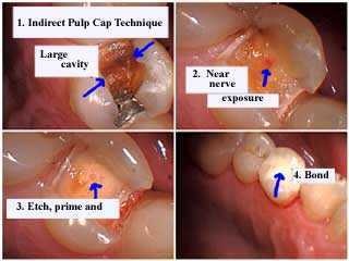 indirect pulp cap capping tooth decay cavity teeth cavities dental caries nerve exposure