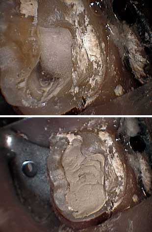 endodontics root canal access teeth opening tooth endodontist drilling preparation