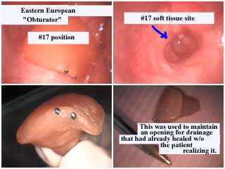 tooth pain teeth infection dental oral mouth infected prosthesis drainage gums drain