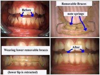 tooth spring aligner, dental appliance, removable braces, orthodontic, invisalign
