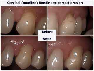 Toothbrush abrasion cervical tooth teeth erosion gum line abfraction dental bonding gumline