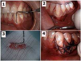 gingival margins mucogingival graft embrasures gum recession receded mucogingival surgery