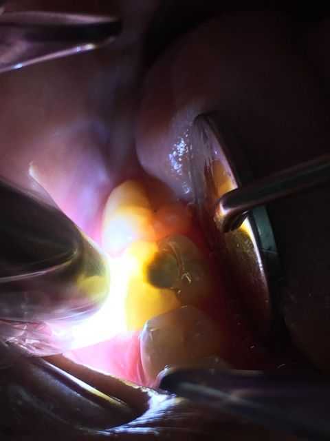 Transillumination shows a fracture in a lower right molar tooth, trans illumination, light
