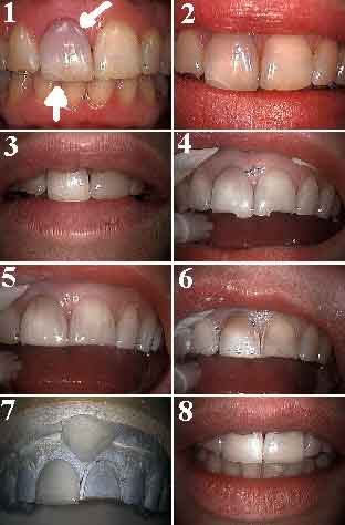 porcelain veneers teeth dental laminates tooth accident trauma broken upper front tooth teeth