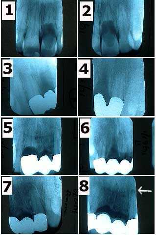 internal resorption external symptoms dental diagnosis treatment therapy extraction xray