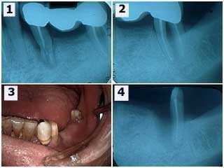 caps, crowns, bridges, bridge, complications, hemisection, root resection, tooth fracture