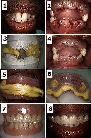 oral rehabilitation dental reconstruction Dr Dorfman smile makeover how to photos
