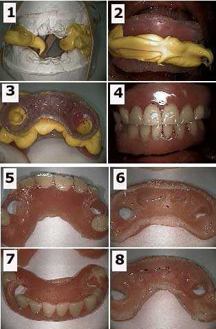 oral rehabilitation dental reconstruction Dr Dorfman smile makeover how to pictures