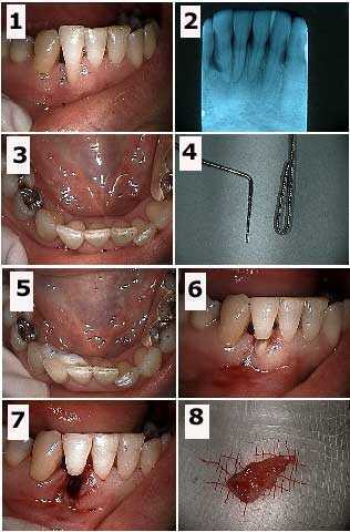Root Resection, tooth hemisection, extracoronal teeth dental splint, Maryland bridge