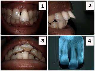 labial flaring flared periodontal gum bone loss orthodontics braces x-ray xray radiographs