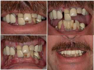 dental phobia dental anxiety dental fear smile makeover for afraid of dentist