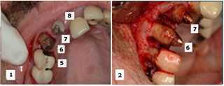 complications problems periodontium periodontia reconstruction, periodontal gum surgery extraction