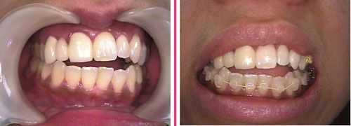 unilateral anterior open bite, midline deviation, dental asymetry teeth
