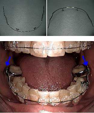 orthodontics coils archwire, molar uprighting, distalization, orthodontia, orthodontist