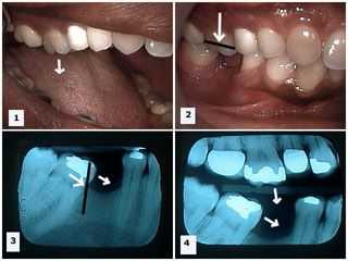supraeruption, mesial drift, tipping, malocclusion, complications, fixed porcelain dental bridges