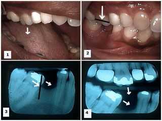 Supra-eruption, supraeruption, mesial drift, tipping, malocclusion, occlusal adjustment