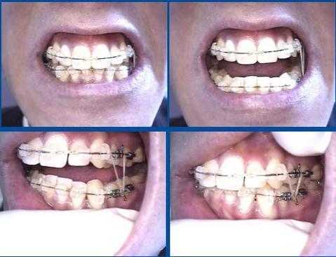vertical elastics, orthodontics, teeth braces, anchorage, power chain, rubber bands symmetry