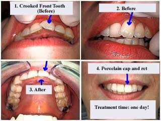 crooked front tooth rotated teeth rotation twisted turned porcelain dental crown cosmetic caps