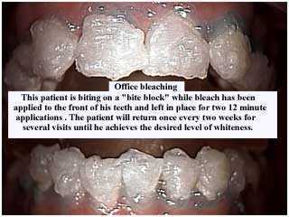Professional teeth whitening or professional teeth bleaching office and tooth whitening for yellow color from coffee stains.