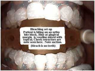 Whitening teeth stains coffee tooth bleaching smile yellow color grey gray discoloration dark