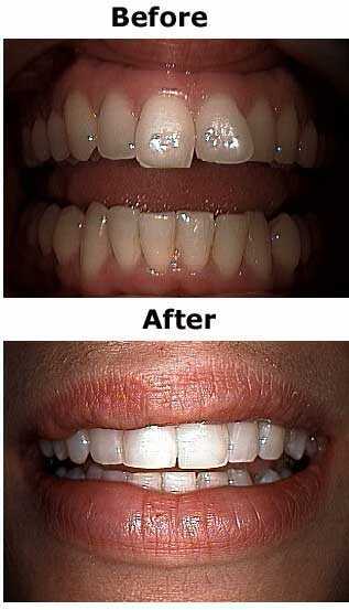 Whitening teeth stains coffee tooth bleaching smile yellow color grey gray before and after